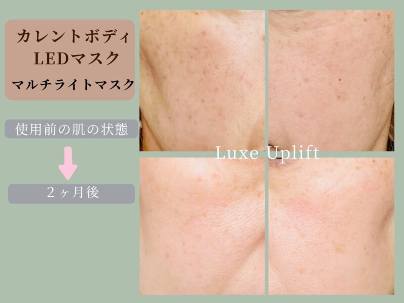 カレントボディLEDマルチライトマスク使用前と2ヶ月後の50代の肌の比較写真。赤みが落ち着き明るい印象に（個人の感想）