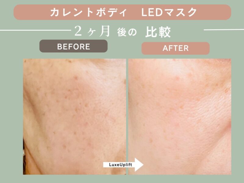 カレントボディLEDマスクを2ヶ月使用した50代の右頬ビフォーアフター。赤みが落ち着き、肌のトーンが均一な印象に（個人の感想）